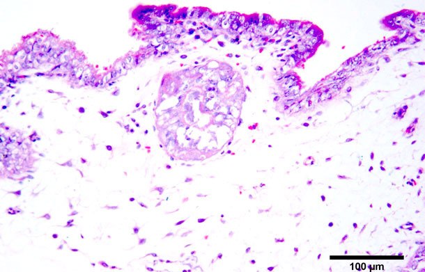 Koagulationsnekrose der Trophoblasten. Hämatoxylin-Eosin-Färbung.