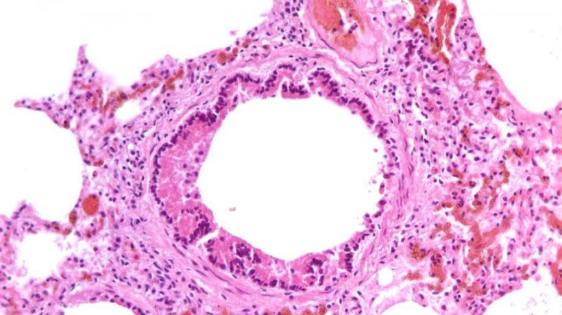 Abbildung 5: Nekrotisierende Bronchiolitis, hervorgerufen durch eine SIV-Infektion
