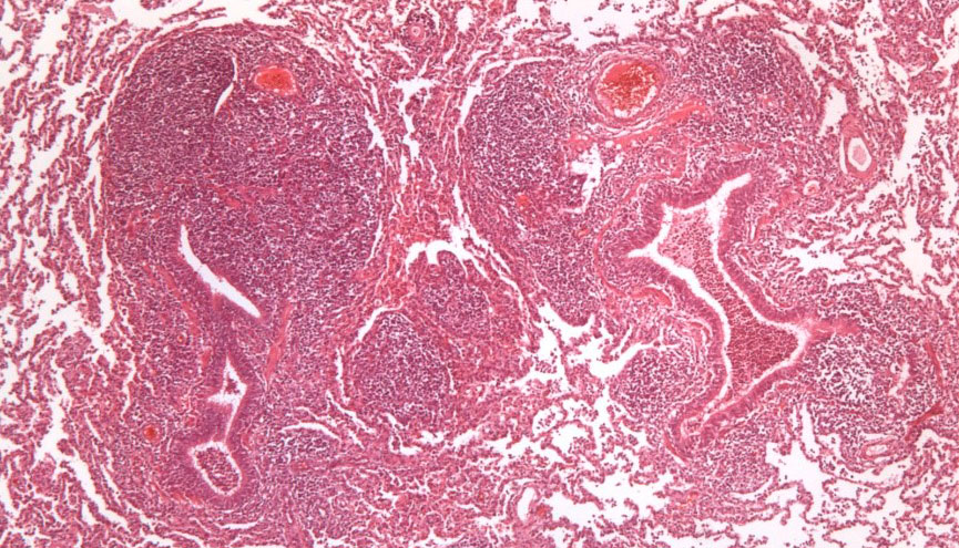 <p>Abbildung 2: Hyperplasie von peribronchiol&auml;rem lymphatischem Gewebe, verursacht durch <em>M. hyopneumoniae</em></p>
