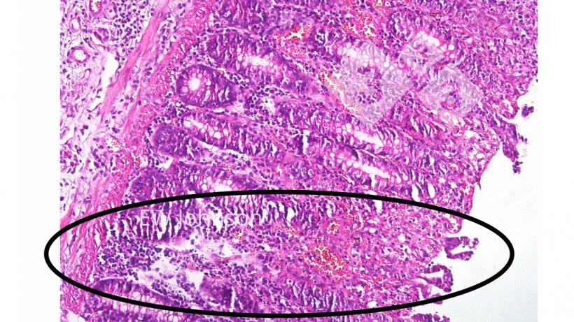 Foto 4: Gef&auml;&szlig;thrombose, Infarkt und Ulzeration in der Dickdarmschleimhaut
